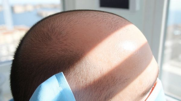 Découvrez les critères essentiels pour un implant capillaire à Nice